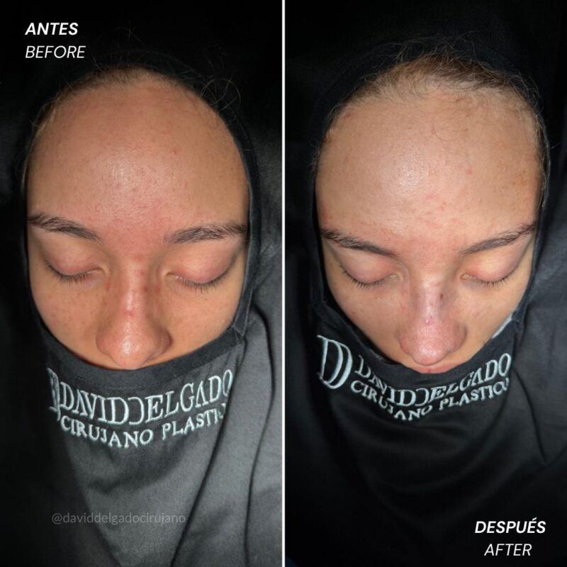 Antes y después Rinoplastia Ultrasónica Dr. David delgado Cirujano Plástico en Medellín