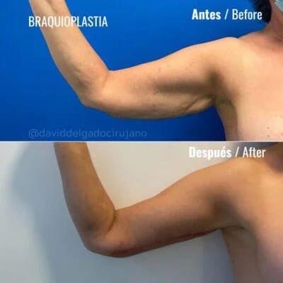 Braquioplastia Antes y después Dr. David Delgado