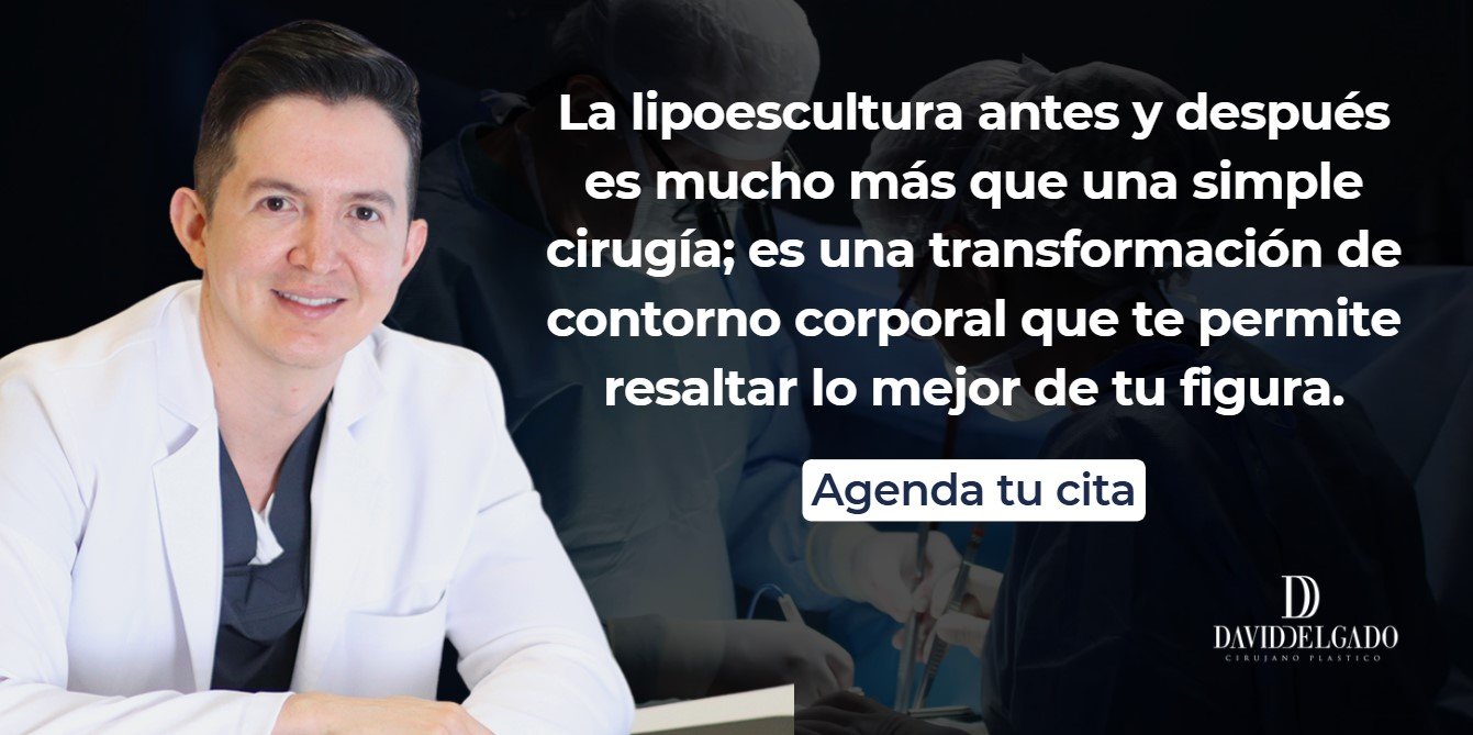 Lipoescultura antes y después- Dr. David Delgado