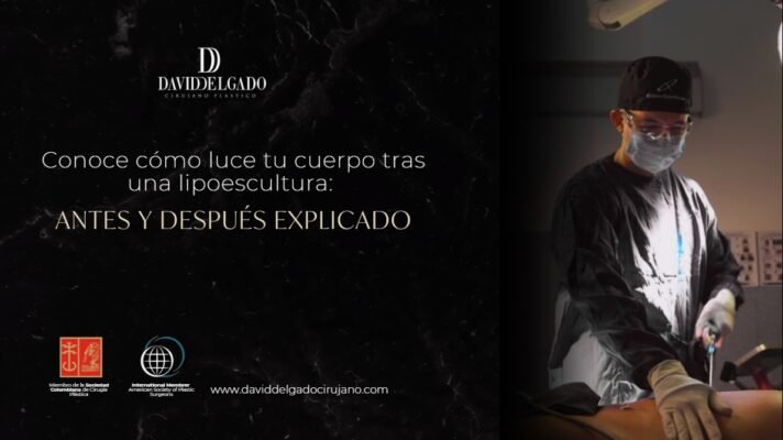 Lipoescultura antes y después- Dr. David Delgado
