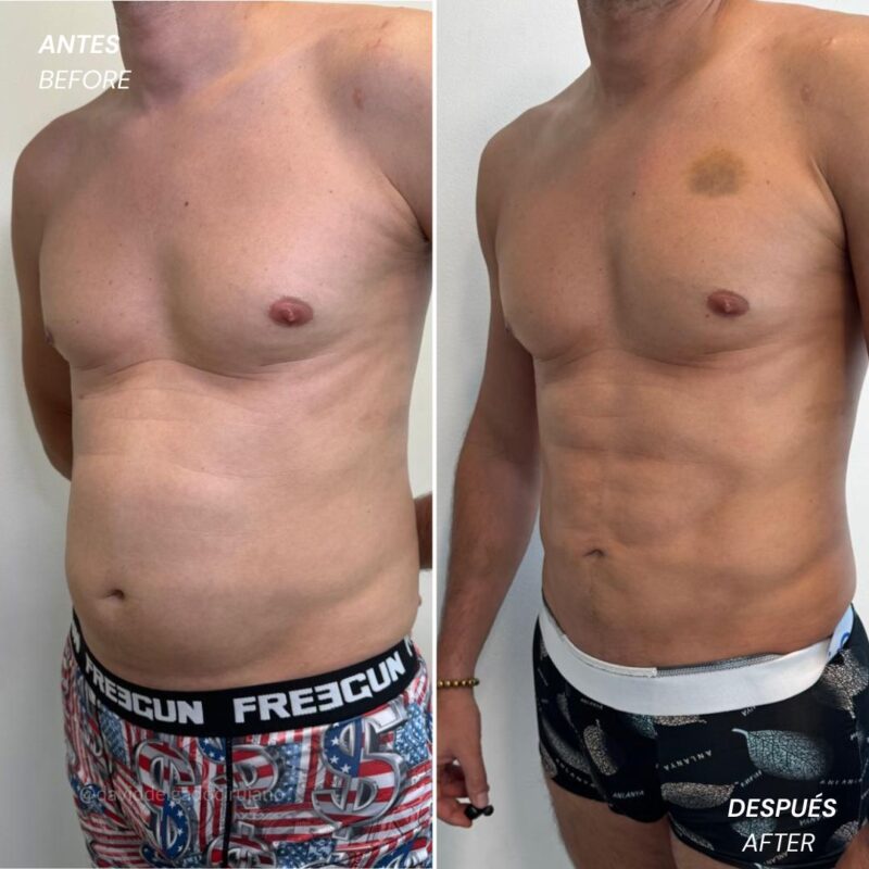 high definition lipo ugraft - Antes y Después - Dr. David Delgado