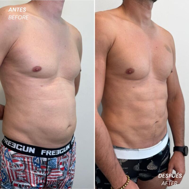 high definition lipo ugraft - Antes y Después - Dr. David Delgado