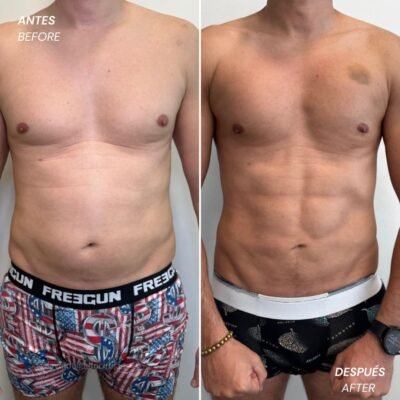 high definition lipo ugraft - Antes y Después - Dr. David Delgado