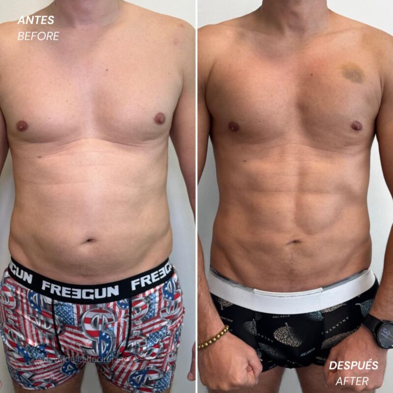 high definition lipo ugraft - Antes y Después - Dr. David Delgado