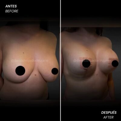 Antes y después Dr. David Delgado Mastopexia con cambio de implantes