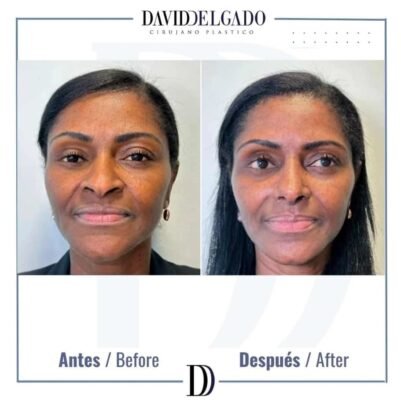 rhinoplasty ethnic before and after - Plastic surgeon in Colombia Dr. David Delgado 5