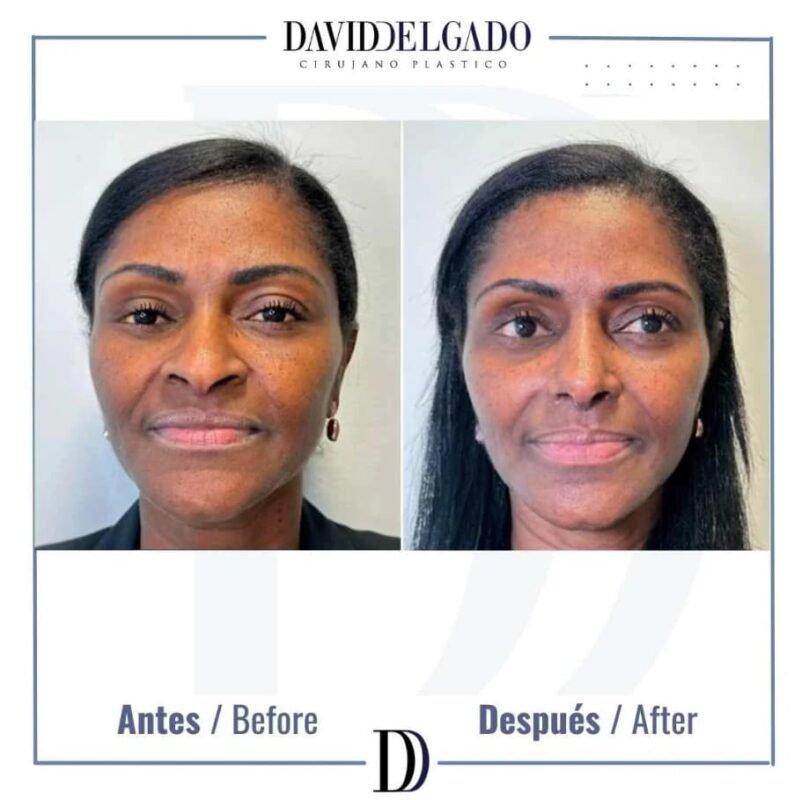 rhinoplasty ethnic before and after - Plastic surgeon in Colombia Dr. David Delgado 5