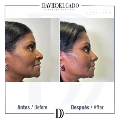 rhinoplasty ethnic before and after - Plastic surgeon in Colombia Dr. David Delgado 6