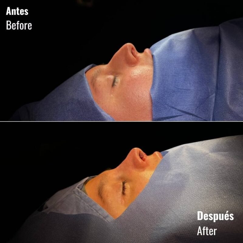 Rinoplastia antes y después - Dr. David Delgado - Cirujano plástico en Medellín, Colombia