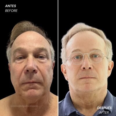 Lifting facial antes y después con el cirujano plástico de Medellín David delgado - 011025