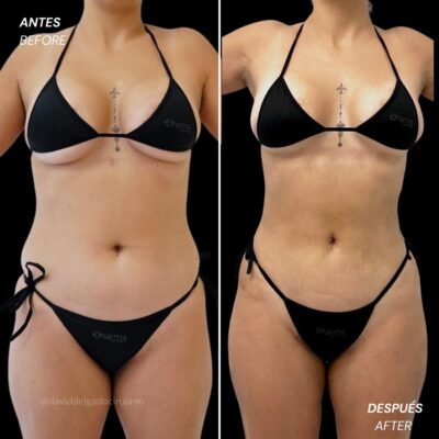 Lipoescultura ultrasónica 360 con gluteoplastia antes y después en la clínica estética Be Dharma - 011025