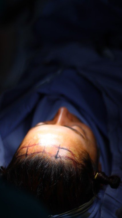 Marcación para una frontoplastia en Colombia con el Dr. David Delgado