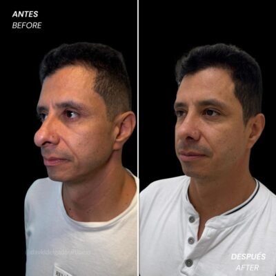 Rinoplastia antes y después con el cirujano plástico de Medellín David delgado - 011025