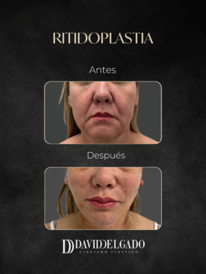 Ritidoplastia en Medellín-Dr. David Delgado