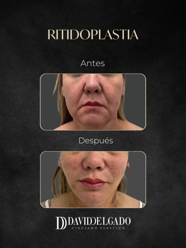 Ritidoplastia en Medellín-Dr. David Delgado