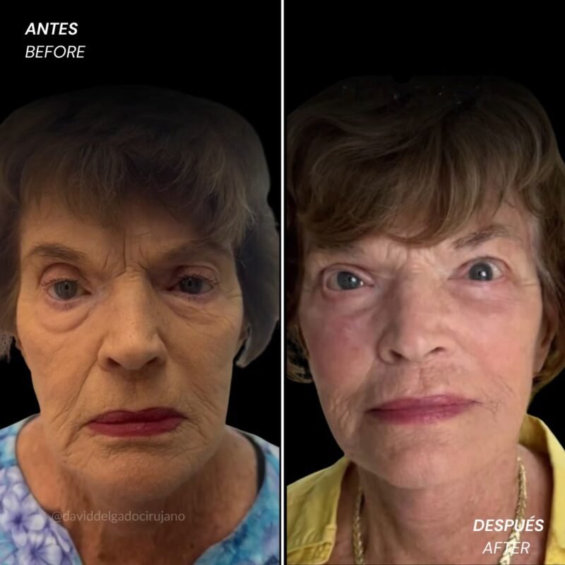 Ritidoplastia antes y después con el cirujano plástico de Medellín David delgado - 041125
