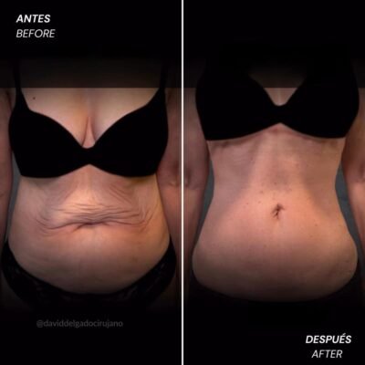 Reverse tummy tuck before and after - David Delgado, plastic surgeon in Colombia