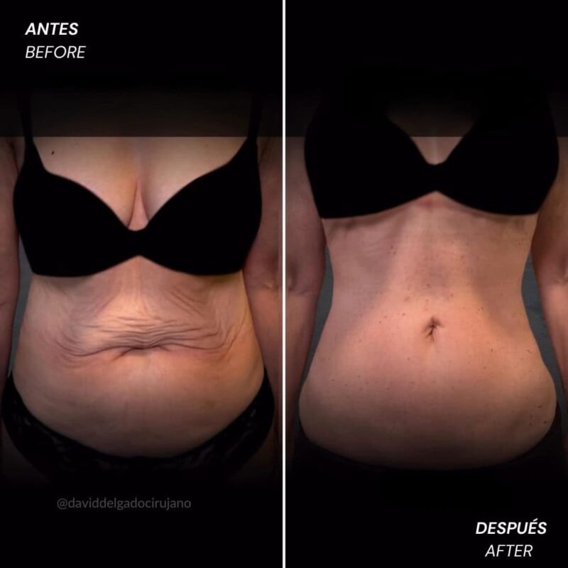 Reverse tummy tuck before and after - David Delgado, plastic surgeon in Colombia