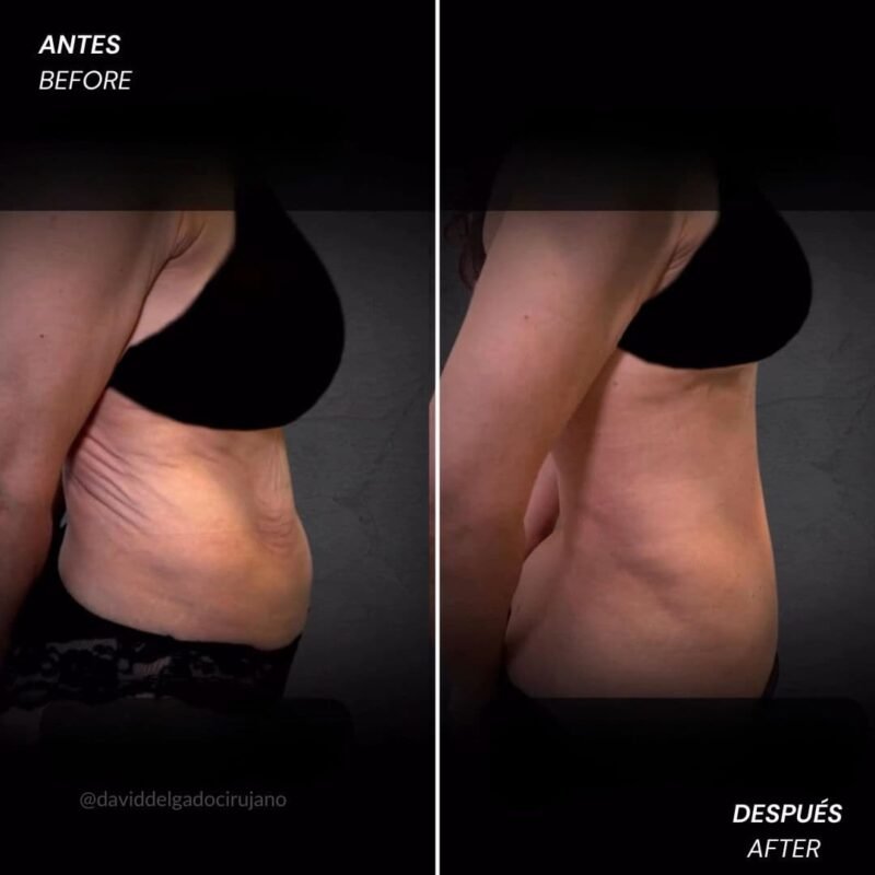 Reverse tummy tuck before and after pics - David Delgado, plastic surgeon in Colombia