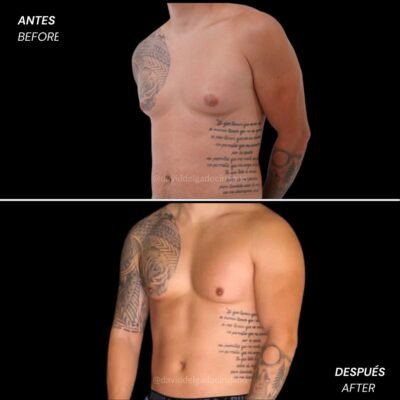 Antes y después de una ginecomastia en hombres - Dr. David Delgado Cirujano Plástico en Medellín