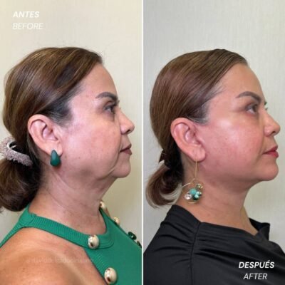 Lifting facial antes y después - Dr. David Delgado 2