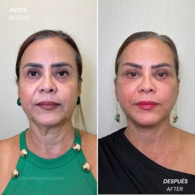 Lifting facial antes y después - Dr. David Delgado