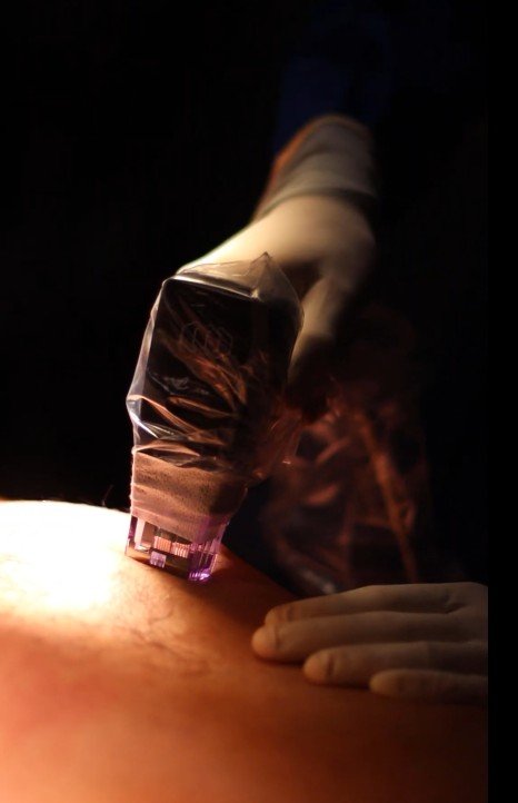 Morpheus en cirugía de ginecomastia - Cirujano plástico de Medellín David Delgado