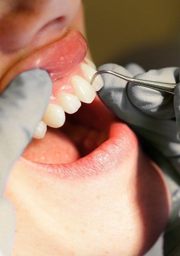 Profilaxis en Medellín - Be Dharma Dental 2