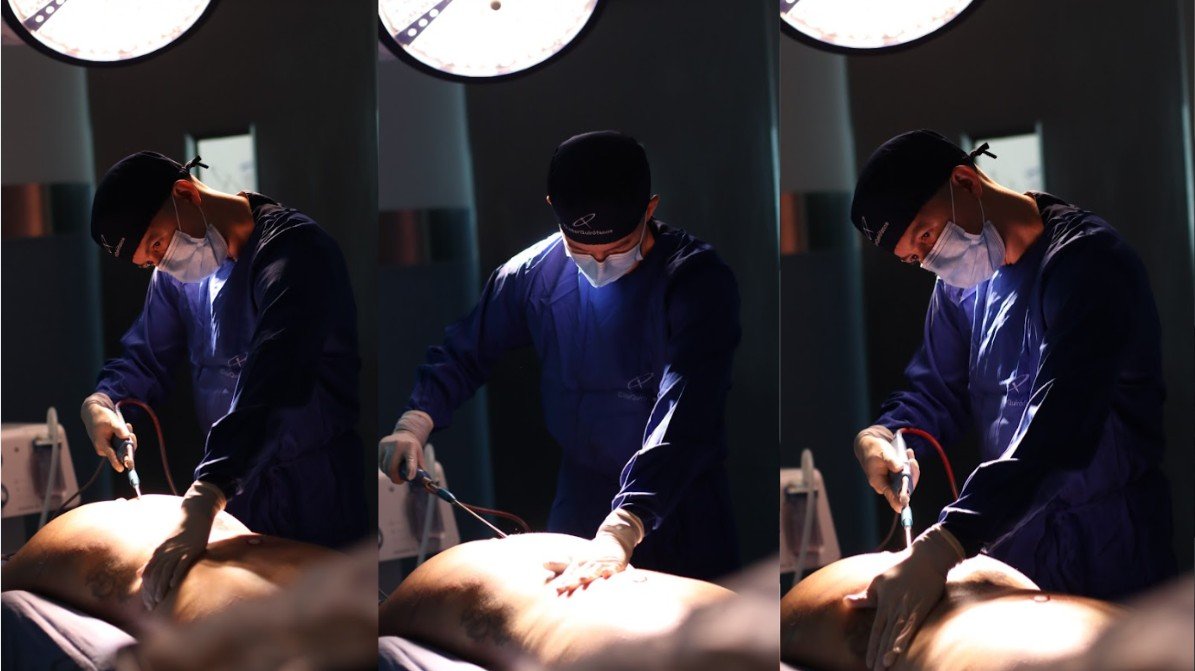 Liposucción antes y después-Dr. David Delgado-Cirujano plástico Medellín