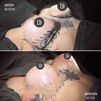 Mastopexia con cambio de implantes en Medellín - Dr. David Delgado - Cirujano Plástico en Medellín