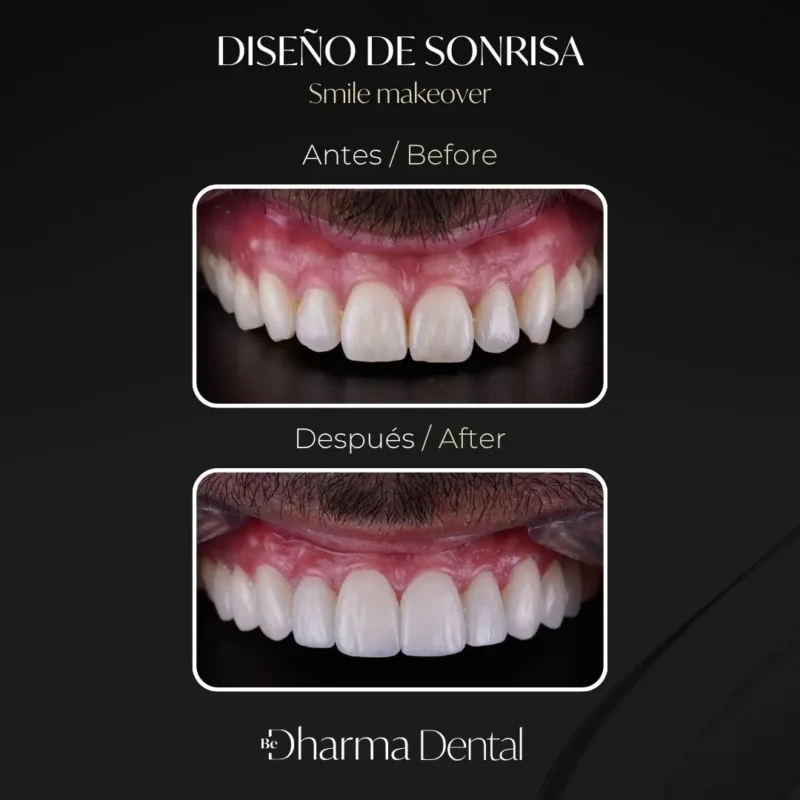 Diseño de sonrisa antes y después en la clínica odontológica Be Dharma Dental - Medellín, Colombia- 060426 2