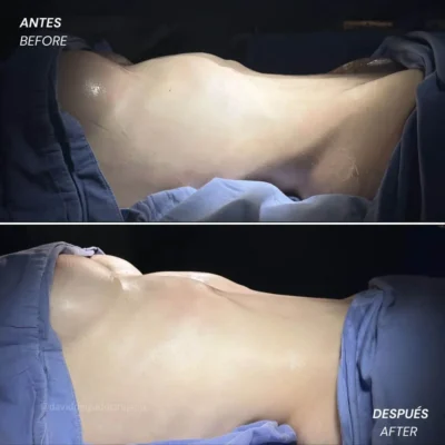 Luxacion-de-costillas antes y después-Dr.-David-Delgado-Cirujano-Plastico-en-Medellin