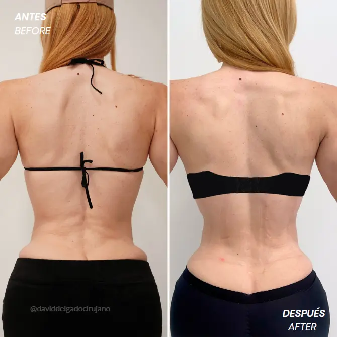 Rib Remodeling Surgery- Dr. David Delgado- Plastic Surgery Medellín