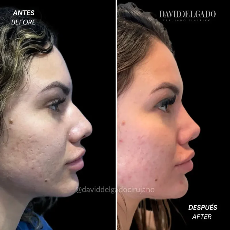 Rinoplastia antes y después 7 de enero 2025 (versión nueva) 3