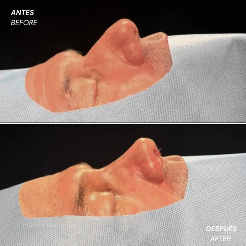 Rinoplastia antes y después con el cirujano plástico de Medellín David delgado - 060426 2