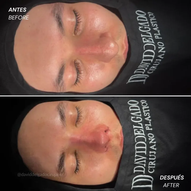 Rinoplastia antes y después con el cirujano plástico de Medellín David delgado - 060426 5