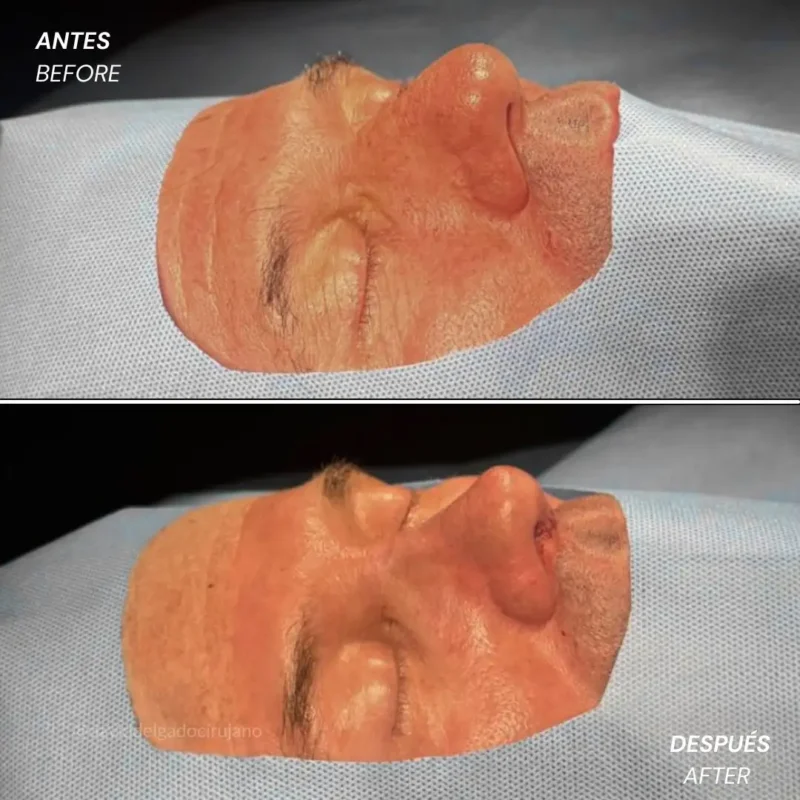 Rinoplastia antes y después con el cirujano plástico de Medellín David delgado - 060426