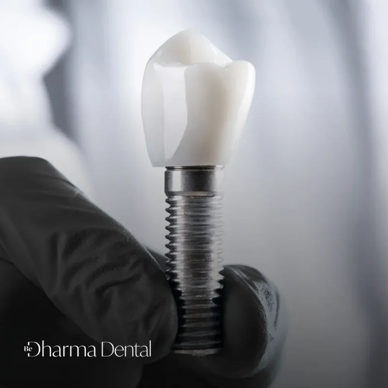 Implantes dentales en Medellín, Colombia - Clínica odontológica Be Dharma Dental - David Delgado cirujano plástico