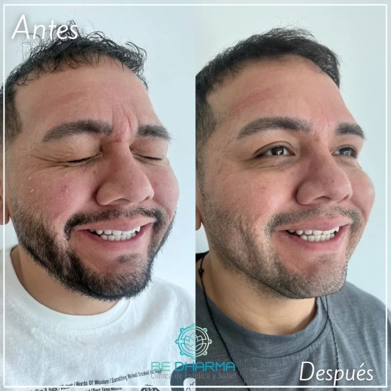 Botox para hombres en Medellín antes y después - Clínica estética Be Dharma