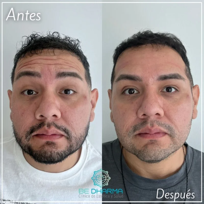 Toxina botulínica para hombres en Medellín antes y después - Clínica estética Be Dharma