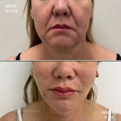 face lift Colombia- Dr. David Delgado in Medellín- Before and after 1