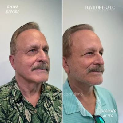face lift Colombia- Dr. David Delgado in Medellín- Before and after