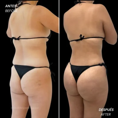 why fat transfer to the buttocks- Dr. David Delgado- Torre Médica de Oviedo
