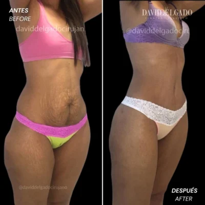Mommy makeover de aumento antes y después - Cirujano plástico de Medellín, Colombia David Delgado - 281219 1.jpg
