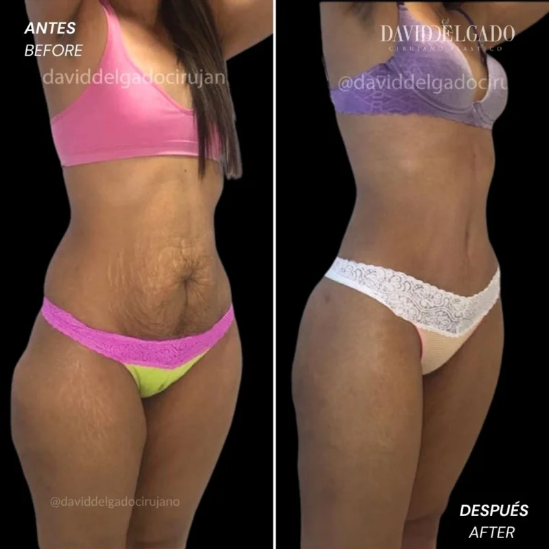 Mommy makeover de aumento antes y después - Cirujano plástico de Medellín, Colombia David Delgado - 281219 1.jpg