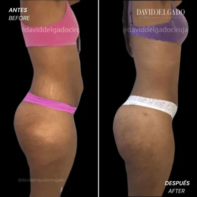 Mommy makeover de aumento antes y después - Cirujano plástico de Medellín, Colombia David Delgado - 281219.jpg