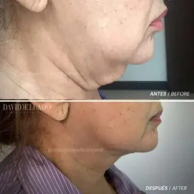 neck lift in Colombia - Dr. David Delgado Medellín - Plastic Surgery