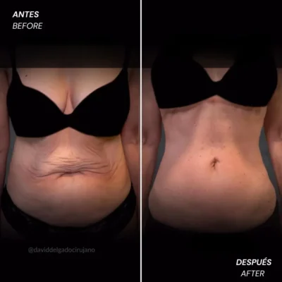 Abdominoplastia casos antes y despúes- Dr. David Delgado