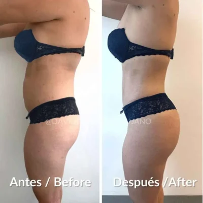 Abdominoplastia casos antes y despúes en Medellín, Colombia- Dr. David Delgado- Cirujano plástico