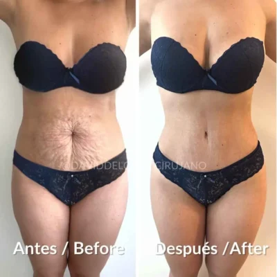 Abdominoplastia casos antes y despúes en Medellín, Colombia- Dr. David Delgado- Cirujano plástico Medellín